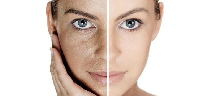 դեմքի մաշկի երիտասարդացումից առաջ և հետո
