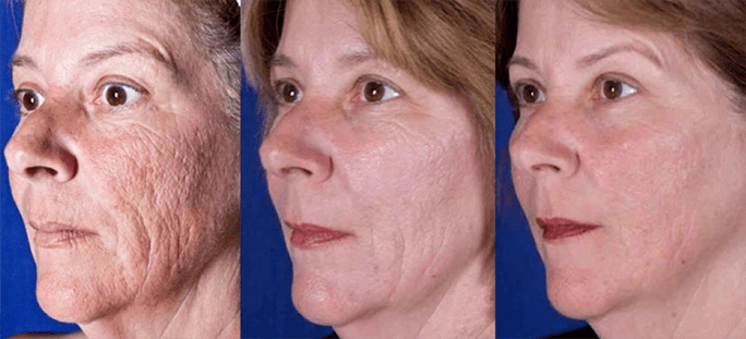 Արդյունքը դեմքի մաշկի լազերային երիտասարդացման ընթացակարգից հետո